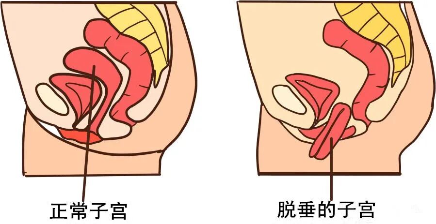 哪些人容易患 盆腔脏器脱垂？
