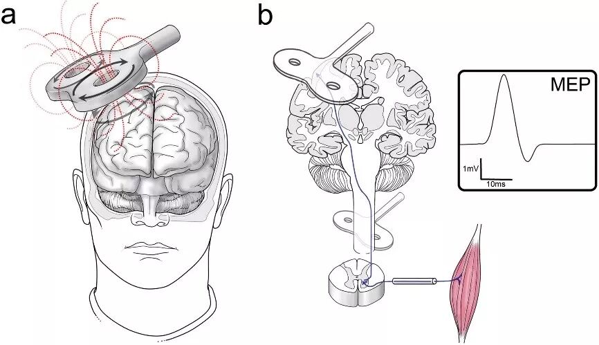 tms什么医疗技术 ｜ 最“科学”的磁疗方法：经颅磁刺激_https://www.jmylbn.com_新闻资讯_第4张