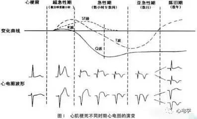 急性心梗心电图，各阶段特点及异常Q波的诊断与鉴别诊断
