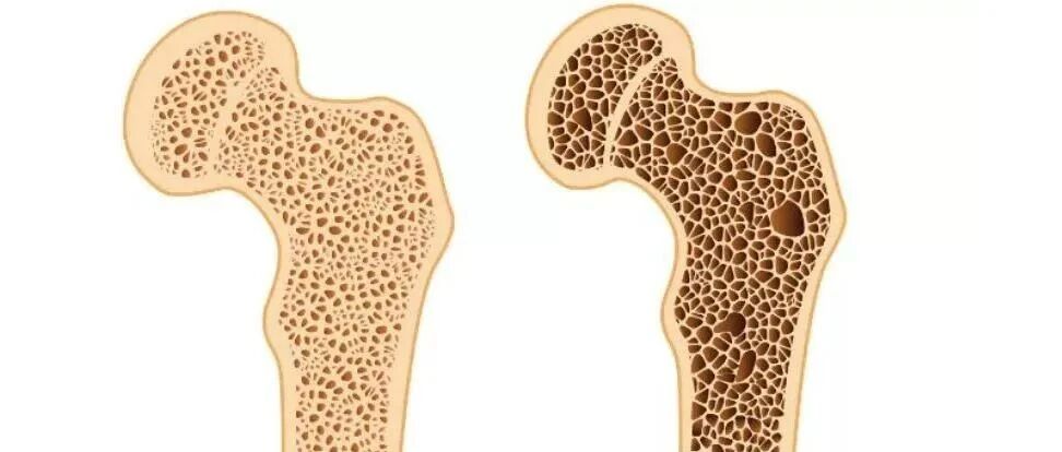 用激素的肾友注意预防骨质疏松