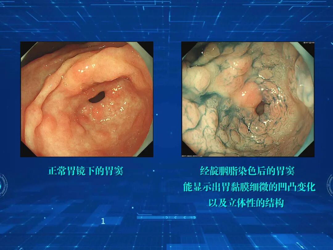 电子胃镜镜是什么超清晰，新“镜”界！｜ 寿县县医院消化内科常规开展无痛放大电子胃镜检查_https://www.jmylbn.com_新闻资讯_第6张