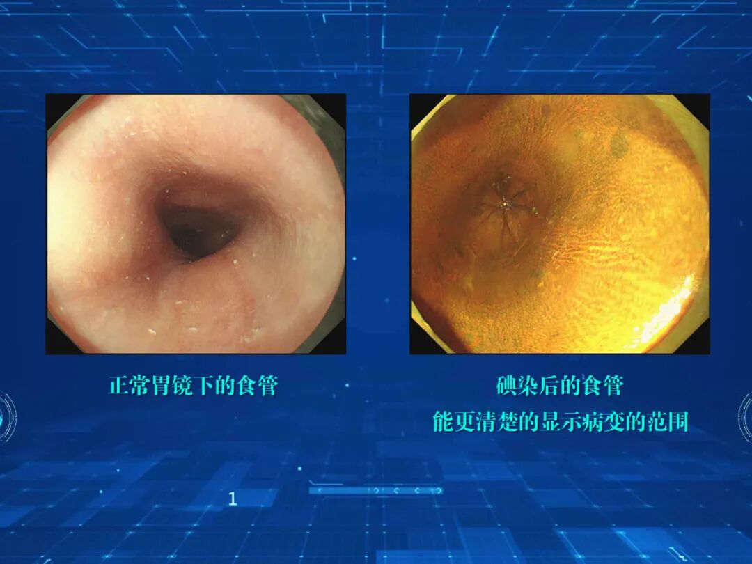 电子胃镜镜是什么超清晰，新“镜”界！｜ 寿县县医院消化内科常规开展无痛放大电子胃镜检查_https://www.jmylbn.com_新闻资讯_第5张