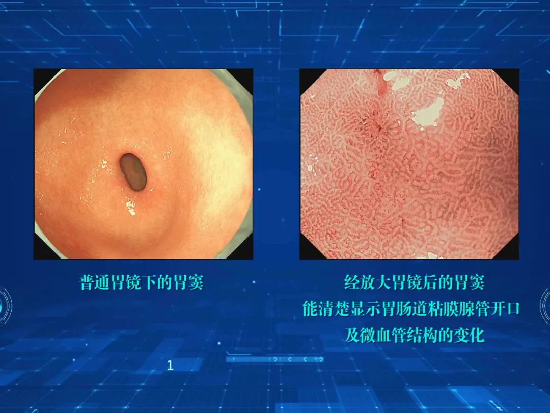 电子胃镜镜是什么超清晰，新“镜”界！｜ 寿县县医院消化内科常规开展无痛放大电子胃镜检查_https://www.jmylbn.com_新闻资讯_第4张
