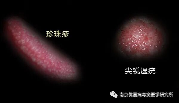 珍珠疹和尖锐湿疣图片 南京优嘉病毒疣医学研究所 微信公众号文章阅读 Wemp
