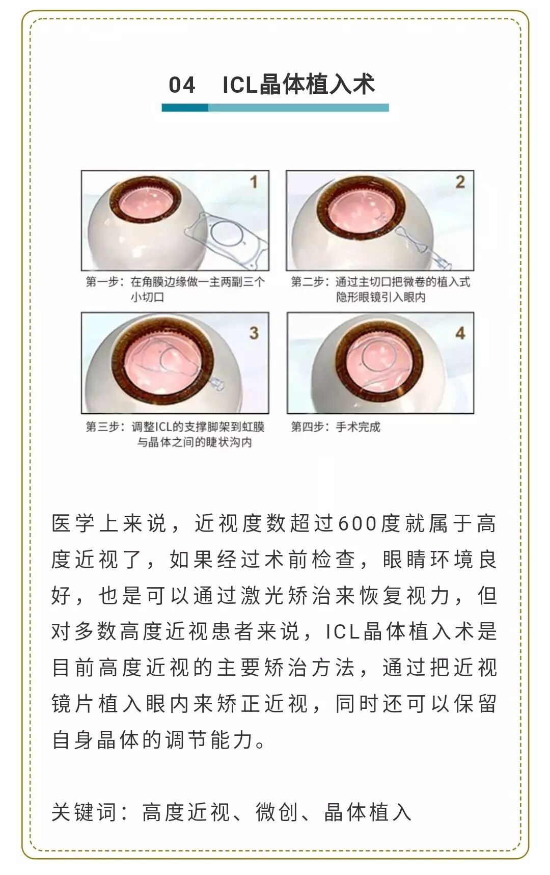 为什么现在做近视手术最合适 品牌资讯 品牌故事 美尔目医院官网