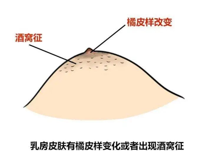 胸部出现“小酒窝”，当心是乳腺肿瘤！
