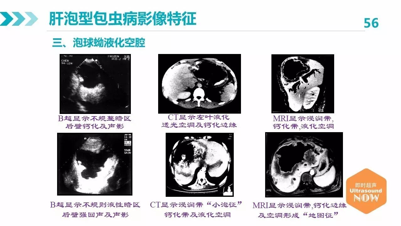 包虫病的影像学特点