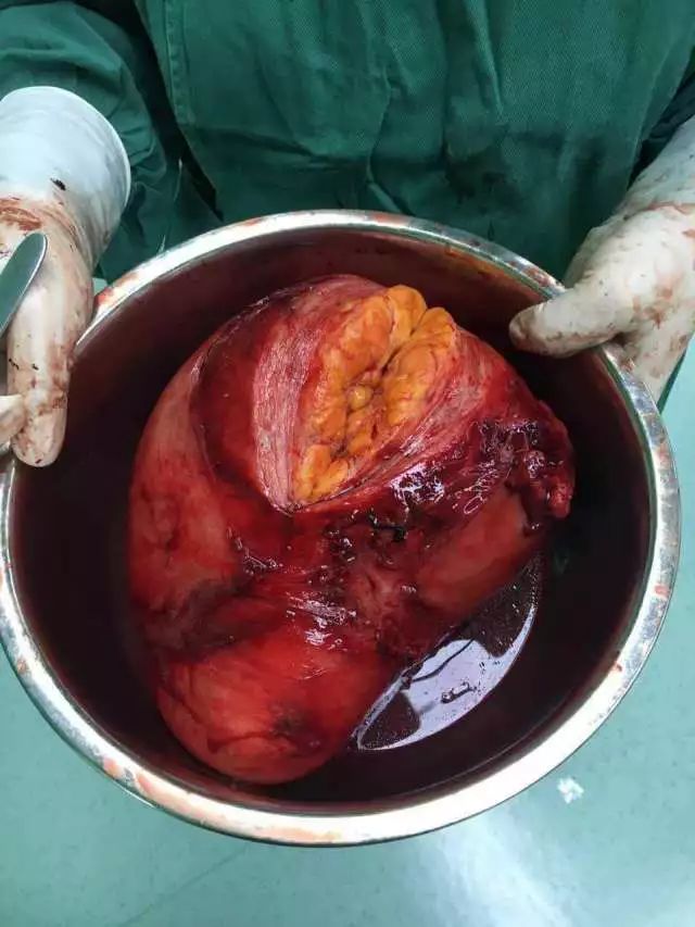 子宫平滑肌瘤大体标本图片