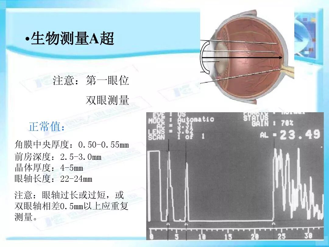 眼科a超报告单怎么看眼科A超 ｜ 基本原理和临床应用_https://www.jmylbn.com_新闻资讯_第18张
