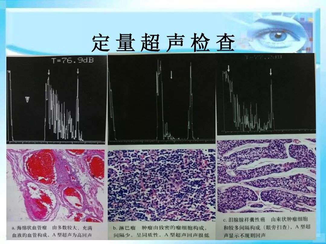 眼科a超报告单怎么看眼科A超 ｜ 基本原理和临床应用_https://www.jmylbn.com_新闻资讯_第31张