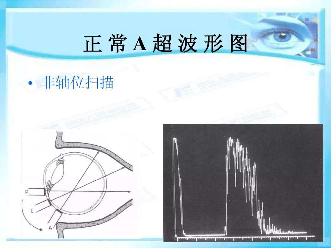 眼科a超报告单怎么看眼科A超 ｜ 基本原理和临床应用_https://www.jmylbn.com_新闻资讯_第13张