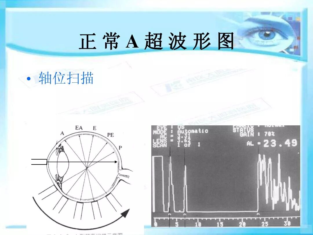 眼科a超报告单怎么看眼科A超 ｜ 基本原理和临床应用_https://www.jmylbn.com_新闻资讯_第12张