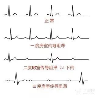 房室传导阻滞