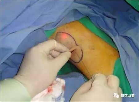 为什么会有腋臭？怎么样才能去掉腋臭？