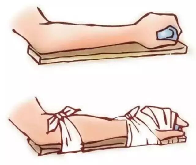 如果发现受伤者有骨折的可能,现场人员一定要先使受伤部位制动.