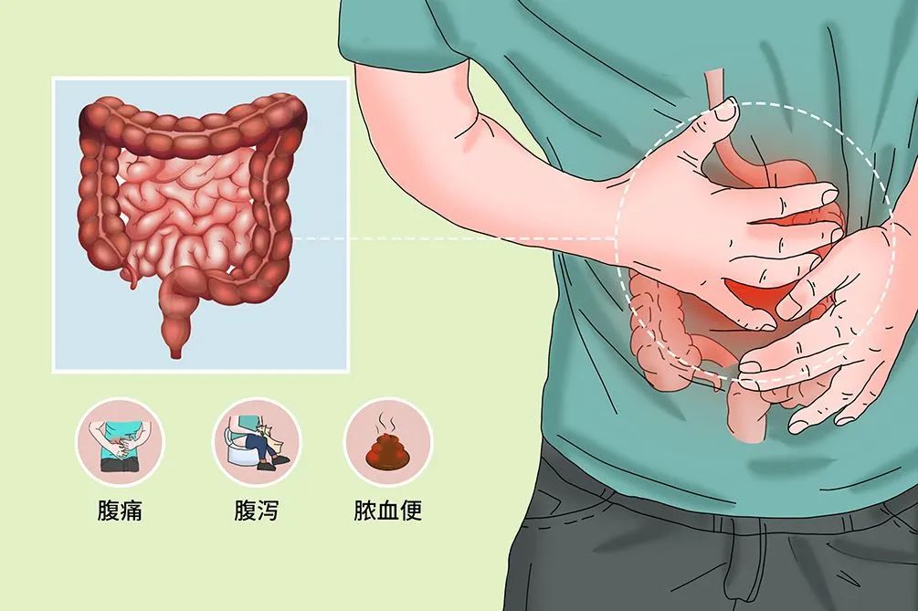 國醫大師李佃貴治療潰瘍性結腸炎經驗