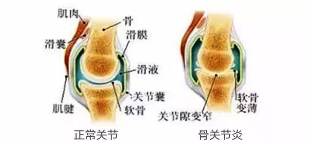治疗骨关节炎有没有特效药？吃什么药最好？
