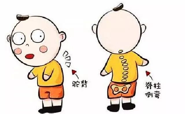 脊柱侧弯|【注意】孩子弯腰驼背、高低肩？可能是患上……