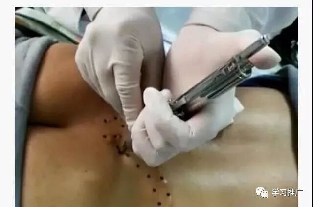 枪针怎么用医用麻醉枪拆卸安装保养维护使用大全【收藏】_https://www.jmylbn.com_新闻资讯_第1张