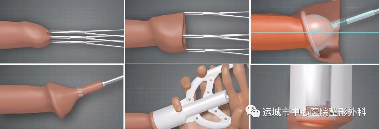 包皮环切器是什么东西一次性包皮环切缝合器——术后恢复快·外形更美观_https://www.jmylbn.com_新闻资讯_第2张