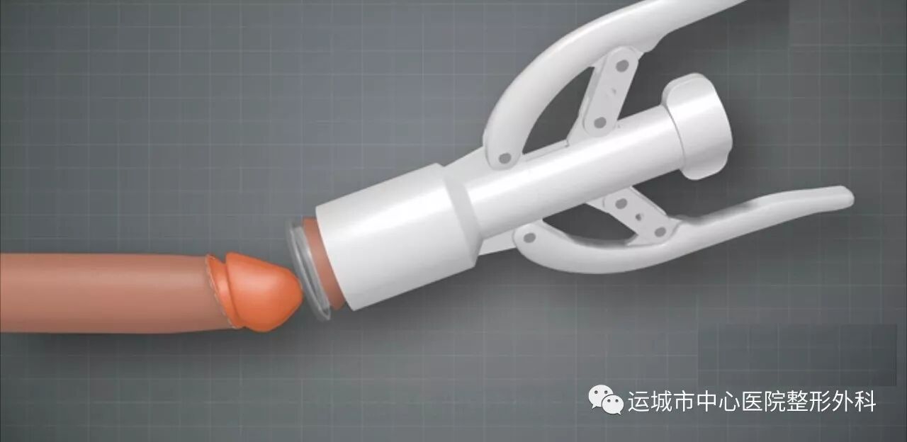 包皮环切器是什么东西一次性包皮环切缝合器——术后恢复快·外形更美观_https://www.jmylbn.com_新闻资讯_第3张