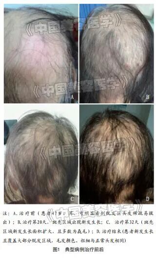 二氧化碳(co2)激光治疗是什么皮肤美容 ｜ 超脉冲点阵CO2激光联合米诺地尔治疗斑秃疗效研究_https://www.jmylbn.com_新闻资讯_第2张