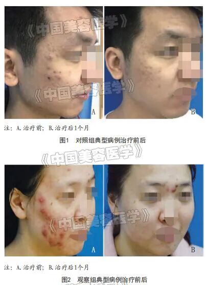 德维可液体敷料怎么用非剥脱性点阵激光联合医用杀菌液体敷料治疗痤疮瘢痕疗效观察_https://www.jmylbn.com_新闻资讯_第2张