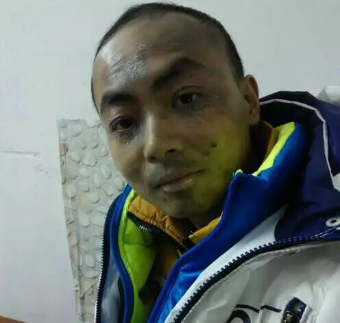 广州南方医院医院根据李伟吉二次移植手术情况给出预算