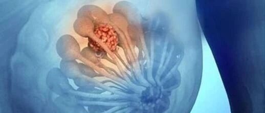 她们的乳腺结节是这样消失的！体检发现乳腺结节的亲们，是时候点进来看看了！