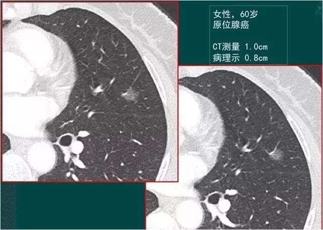 29歲姑娘查出肺結節肺腺癌！醫生卻說幸虧她得了另外一種病！ 健康 第4張