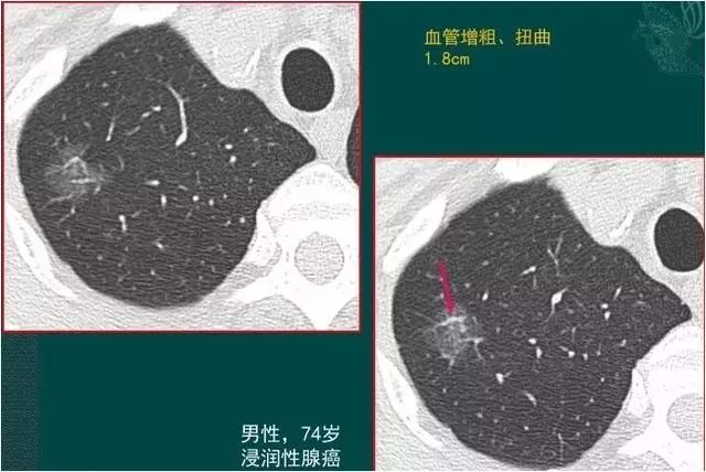 29歲姑娘查出肺結節肺腺癌！醫生卻說幸虧她得了另外一種病！ 健康 第5張