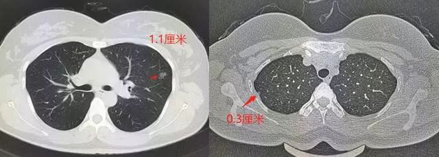 29歲姑娘查出肺結節肺腺癌！醫生卻說幸虧她得了另外一種病！ 健康 第1張