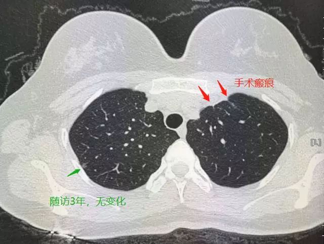 29歲姑娘查出肺結節肺腺癌！醫生卻說幸虧她得了另外一種病！ 健康 第3張