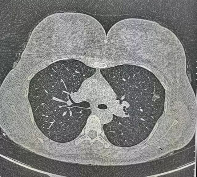 29歲姑娘查出肺結節肺腺癌！醫生卻說幸虧她得了另外一種病！ 健康 第2張