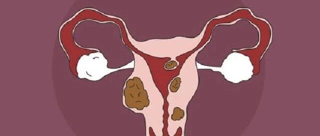 子宫肌瘤竞然怕它，从5.9cm到消失仅3个月，后悔知道晚了！