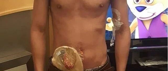 失去肛门，感染艾滋，被性无知摧毁的年轻生命！