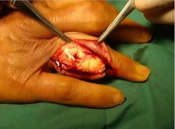 痛风到底有多可怕,这篇文章说透了!