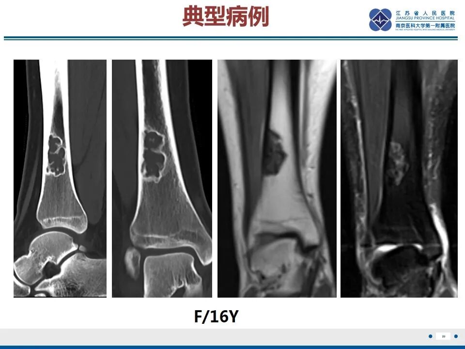 非骨化性纤维瘤影像表现与鉴别