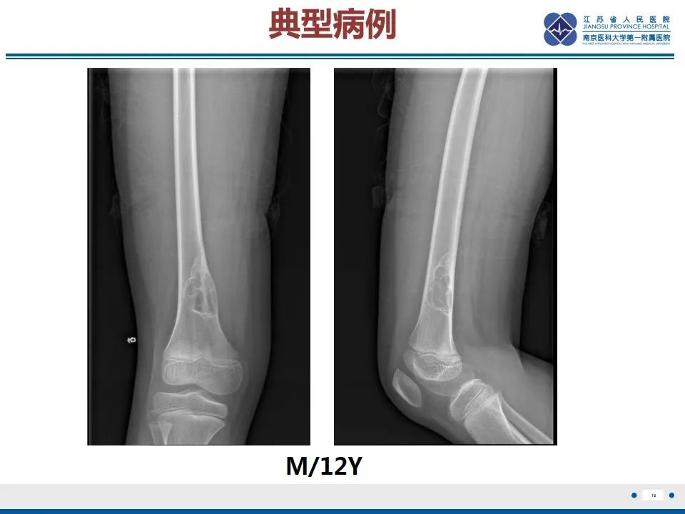 非骨化性纤维瘤影像表现与鉴别