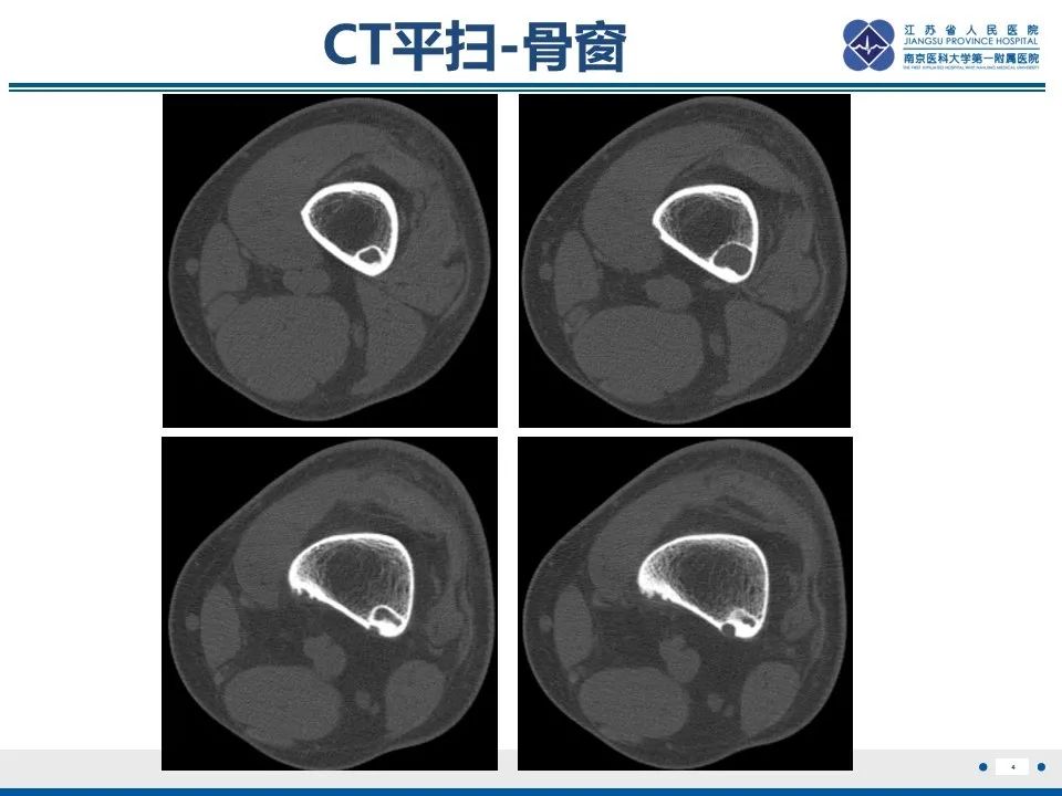 非骨化性纤维瘤影像表现与鉴别