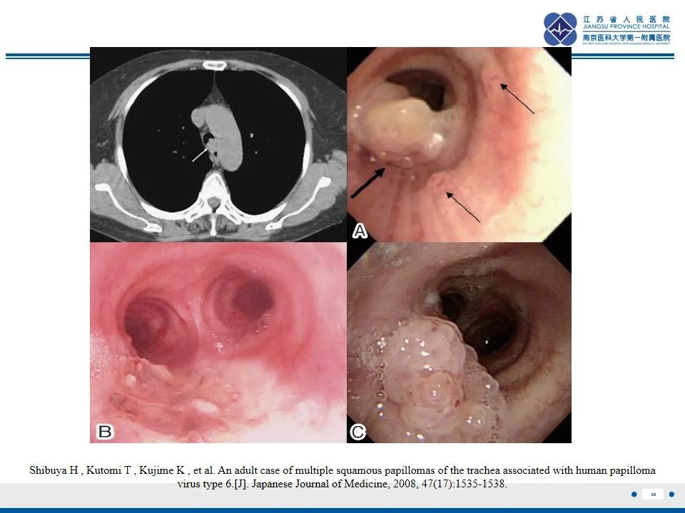 气管肿瘤的早期症状图片