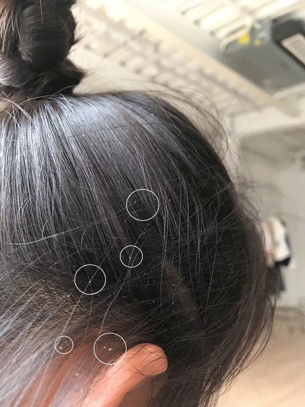 天天給女兒洗頭 竟洗出滿頭蝨子 只因這個小錯誤 父母網 微文庫