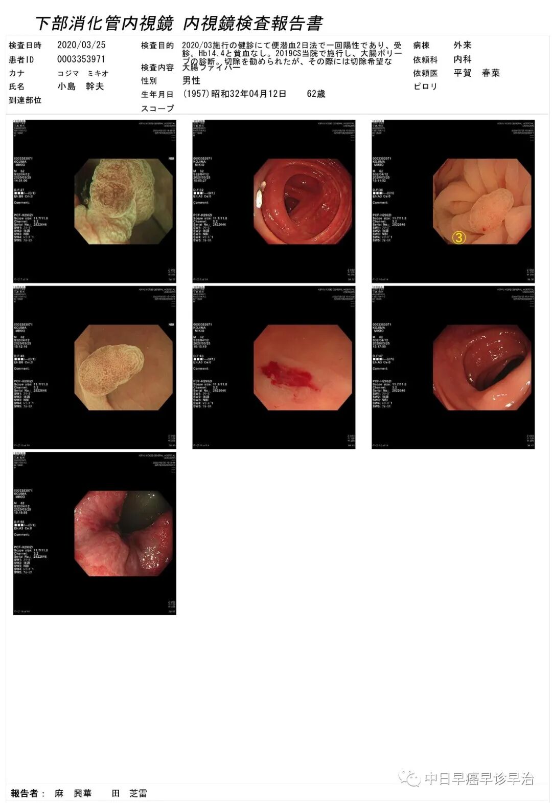 什么是圈套器切除息肉冷切除的圈套器以及其它器械选择（包括今天大家讨论的冷切除的各种问题总结）-上海聚慕医疗器械有限公司