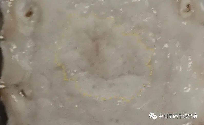 苏木素染色后(胃窦标本)苏木素染色后(胃窦标本)病变范围福尔马林固定后标