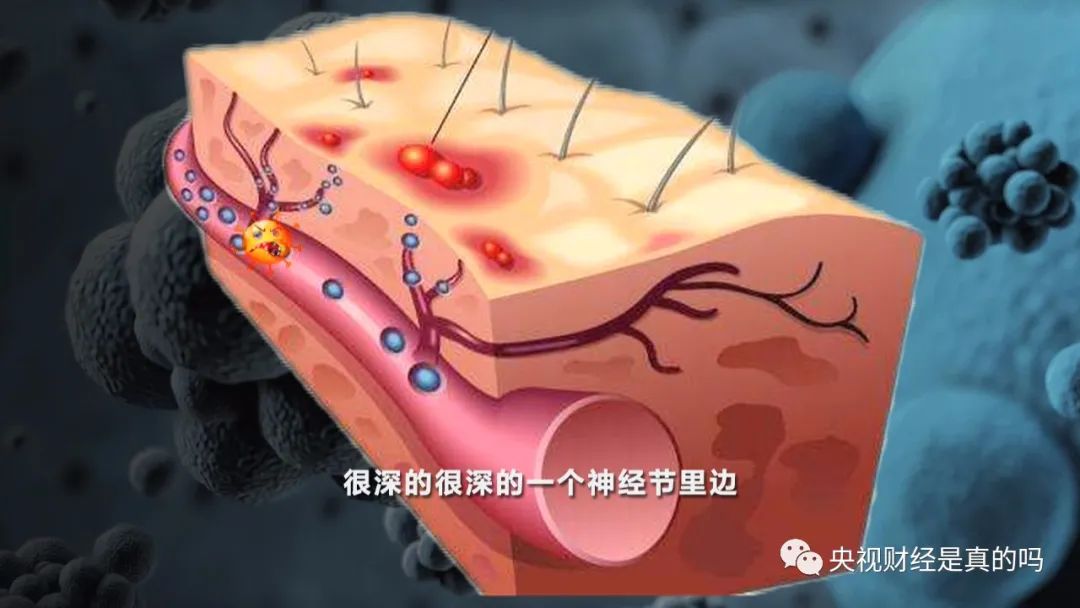 健康真相no7帶狀皰疹痊癒後疼痛就會停止是真的嗎