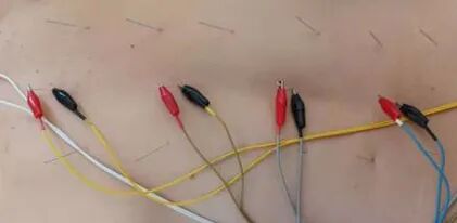 电热针灸怎么做科学就医 ▏跟您说说电热针！_https://www.jmylbn.com_新闻资讯_第6张