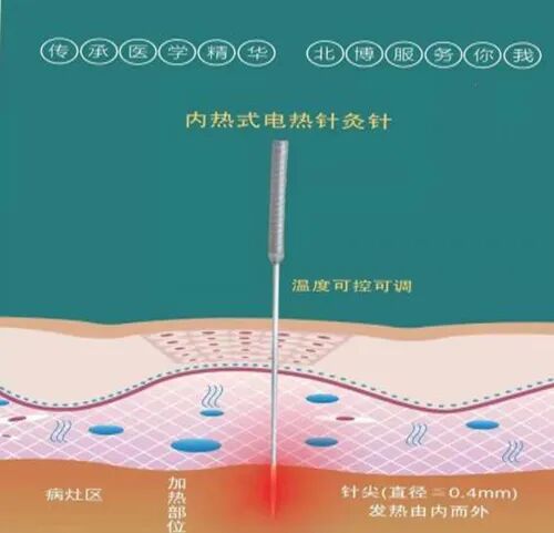 电热针灸怎么做科学就医 ▏跟您说说电热针！_https://www.jmylbn.com_新闻资讯_第2张