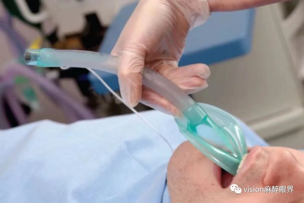 为什么要用喉罩热点回顾｜喉罩应用的五大误区_https://www.jmylbn.com_新闻资讯_第2张