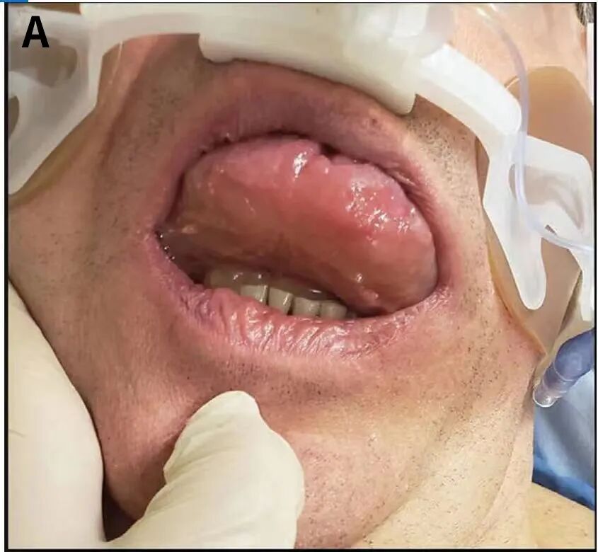 为什么要用喉罩围术用药丨喉罩置入后诱发血管性水肿，竟然是ACEI惹的祸！_https://www.jmylbn.com_新闻资讯_第3张