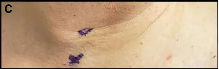 为什么要用喉罩围术用药丨喉罩置入后诱发血管性水肿，竟然是ACEI惹的祸！_https://www.jmylbn.com_新闻资讯_第5张